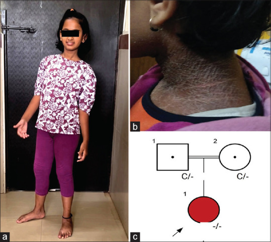 Novel CHKB Mutation Causing Megaconial Congenital Muscular Dystrophy: A Case Report from India.