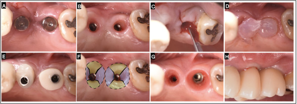 Implant supracrestal complex conditioning through the "x technique" to achieve an enhanced muco-cervical imprint. Case reports.