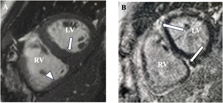 Vascular-variant cardiac amyloid: Cardiac MRI and histopathological appearances.