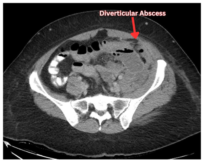 Diverticular Abscess and Percutaneous Drainage Outcomes: A Review of Clinical Practice for the Primary Team.
