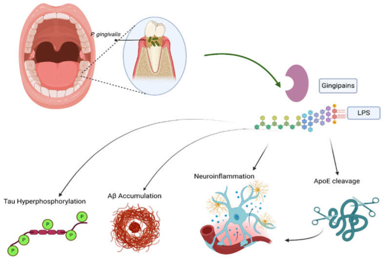 Reciprocal Interactions Between Periodontal Disease and Alzheimer's Disease: Implications for Mutual Triggering, Exacerbation, and Treatment Interventions-A Comprehensive Review of the Literature.