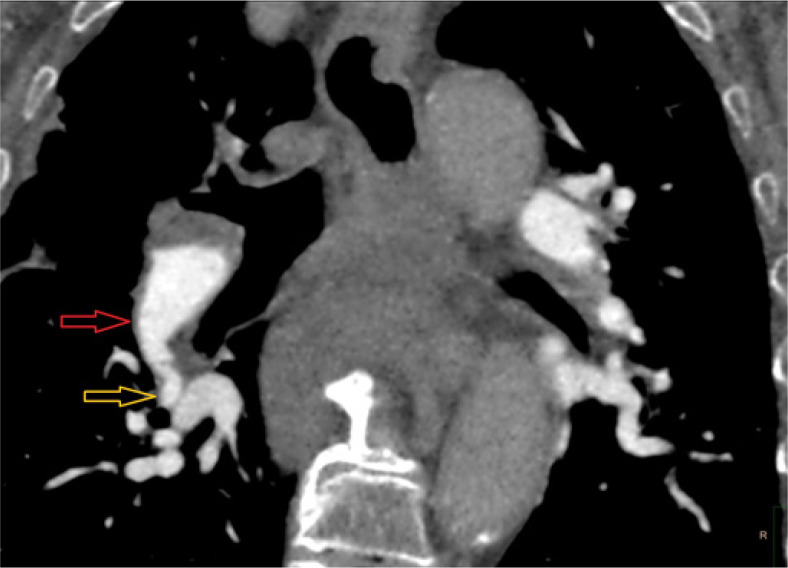 Chronic thromboembolic hypertension predictors in computed tomography angiography. Single-centre study.