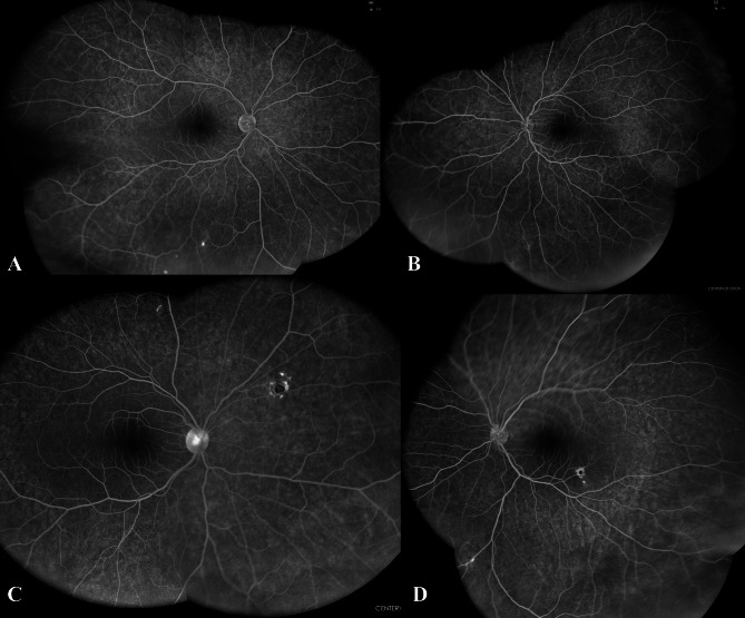 Concurrent uveitis in monozygotic twins in the context of systemic sarcoidosis.