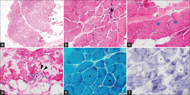 Novel CHKB Mutation Causing Megaconial Congenital Muscular Dystrophy: A Case Report from India.