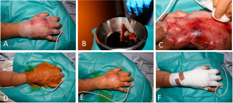 The Reconstruction of Various Complex Full-Thickness Skin Defects with a Biodegradable Temporising Matrix: A Case Series.