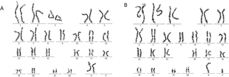 Optical genome mapping enhances cytogenetic analysis in recurrent miscarriage: confirmation of a suspected (1;10) chromosomal translocation.