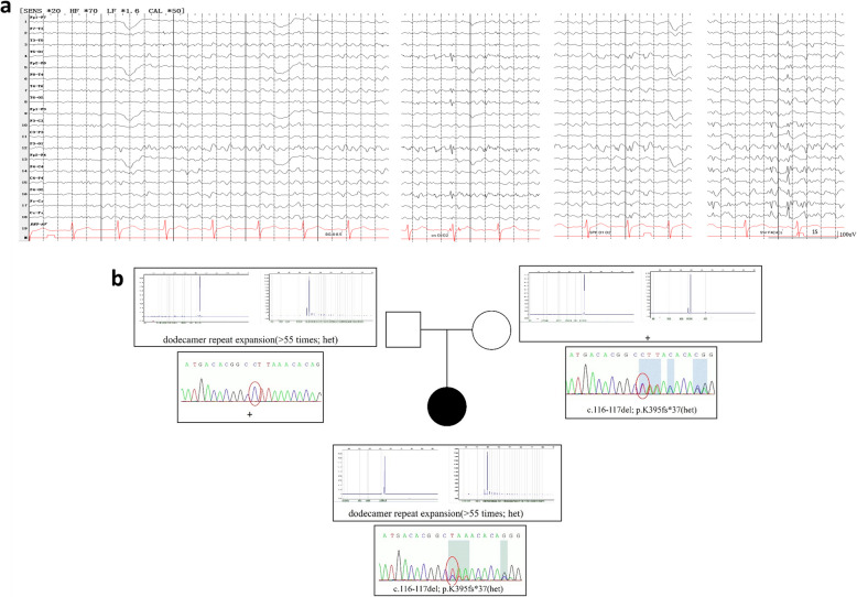 A novel c.116 - 117 del variant in Unverricht-Lundborg disease: first ULD report in large Chinese population and review of the pathogenetic variants in CSTB gene.