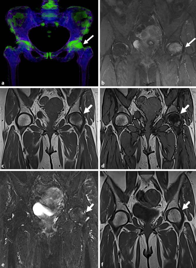 Bone marrow lesions related to bone marrow edema syndromes and osteonecrosis.