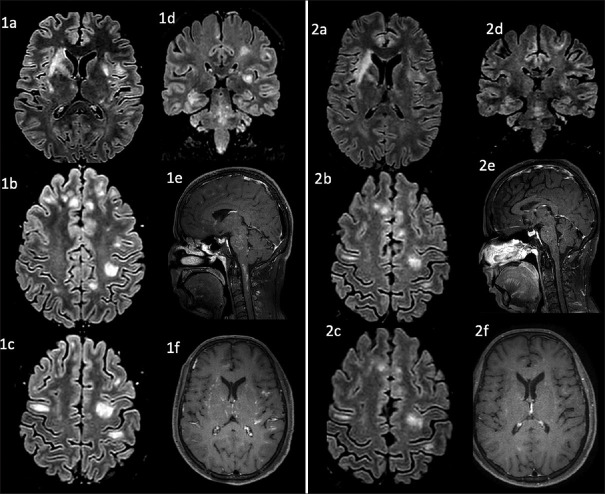 A Case of Supratentorial Lymphocytic Inflammation with Parenchymal Perivascular Enhancement Responsive to Steroids (SLIPPERS) with Associated Chronic Lymphocytic Inflammation with Pontine Perivascular Enhancement Responsive to Steroids (CLIPPERS) and a Review of Literature.