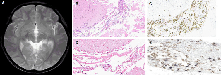 Histopathological characteristics of Epstein-Barr virus (EBV)-associated encephalitis and colitis in chronic active EBV infection.