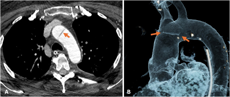 The 'DIMPLE SIGN' of Intra-Aortic Cord.