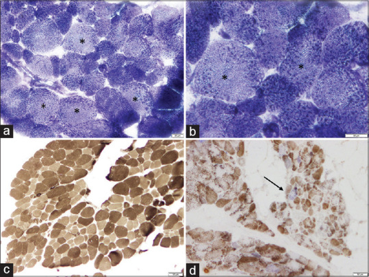 Novel CHKB Mutation Causing Megaconial Congenital Muscular Dystrophy: A Case Report from India.