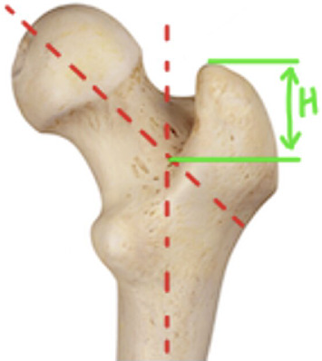 Variations in Greater Trochanter Height as a Relation to Patient Demographics: Implications for Femoral Nail Design.