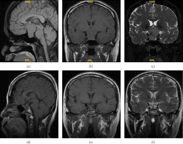 Multidisciplinary Management of Pituitary Neuroendocrine Tumors During Pregnancy: Institutional Report.