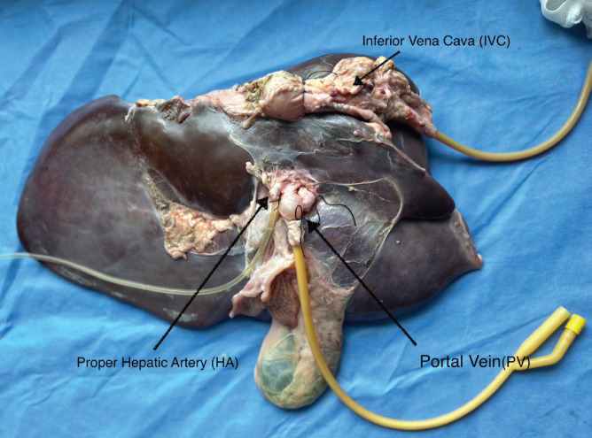Creating a sustainable and inexpensive dry animal training model for liver surgery in low- and middle-income countries.
