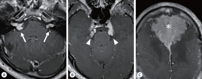 Clinical and Genetic Overview of Neurofibromatosis Type 2 (NF2).
