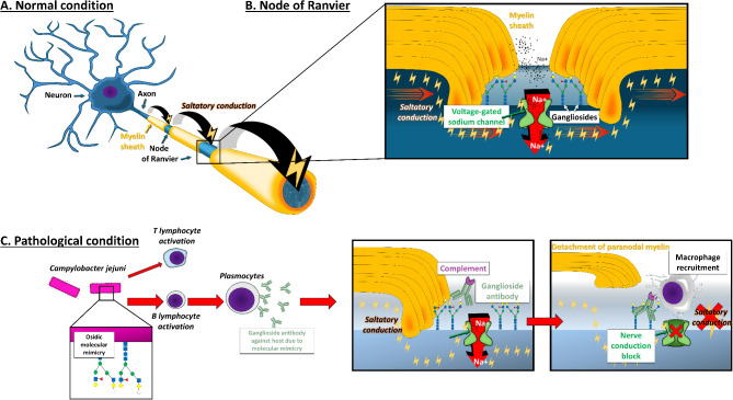 Critical insights for intensivists on Guillain-Barré syndrome.