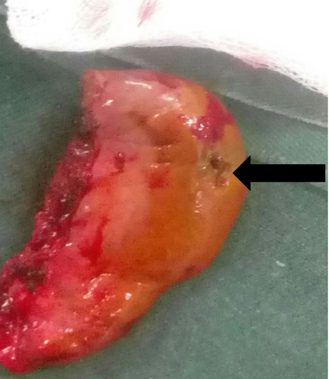 Gallbladder perforation as a rare complication of minor blunt abdominal trauma: a case report.