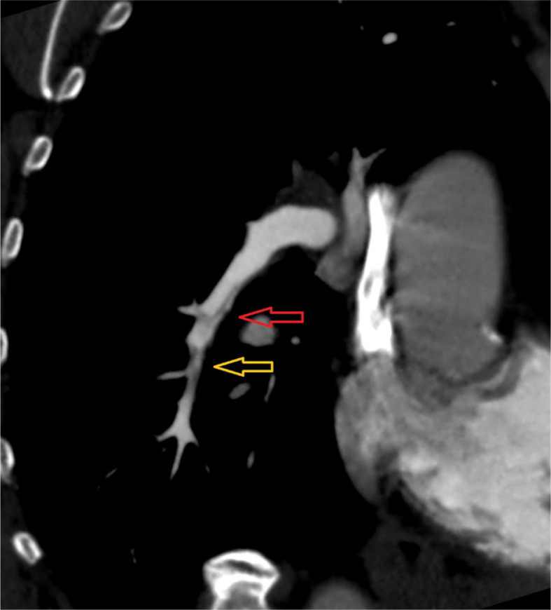 Chronic thromboembolic hypertension predictors in computed tomography angiography. Single-centre study.