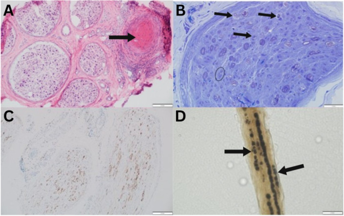 Anti-Neutrophil Cytoplasmic Antibody-Associated Central and Peripheral Nervous System Vasculitis.