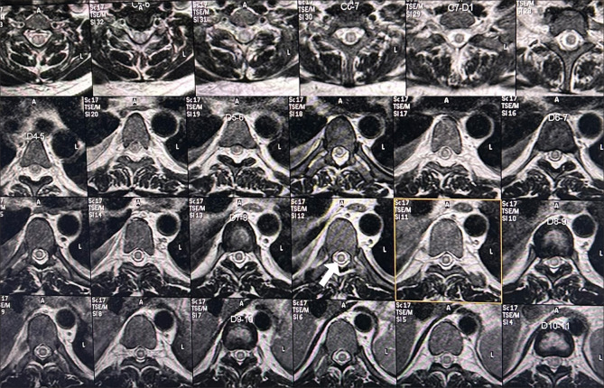 Dengue-Associated Myelin Oligodendrocyte Glycoprotein Antibody-Positive Longitudinally Extensive Transverse Myelitis.