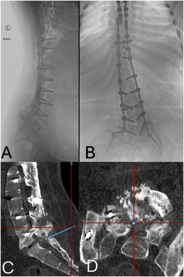Use of O-arm to place an intrathecal catheter through a bony fusion mass: case report.