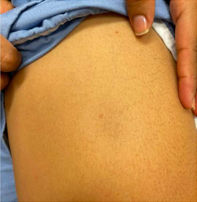 Rosai-Dorfman Disease Case Report.
