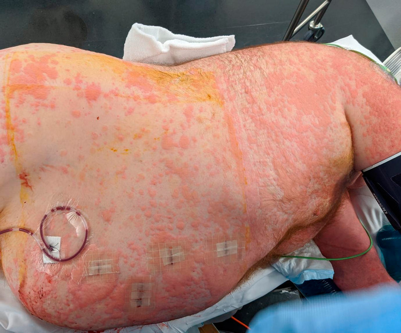 Prolonged life-threatening anaphylaxis to Floseal during partial nephrectomy: A case report.