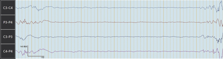 The Application Value of Early Amplitude-Integrated Electroencephalogram in a Newborn with Nonketotic Hyperglycinemia: A Rare Case Report.