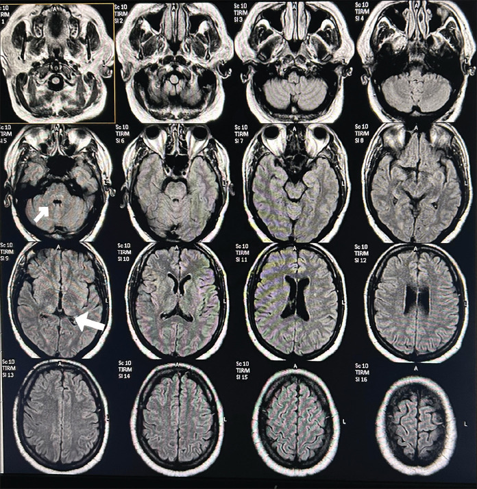 Dengue-Associated Myelin Oligodendrocyte Glycoprotein Antibody-Positive Longitudinally Extensive Transverse Myelitis.