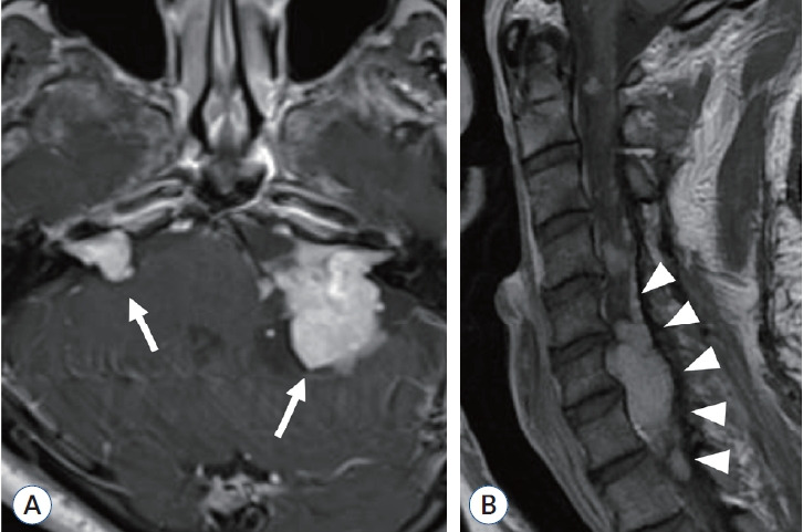 Clinical and Genetic Overview of Neurofibromatosis Type 2 (NF2).