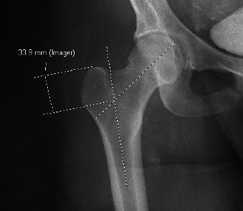 Variations in Greater Trochanter Height as a Relation to Patient Demographics: Implications for Femoral Nail Design.