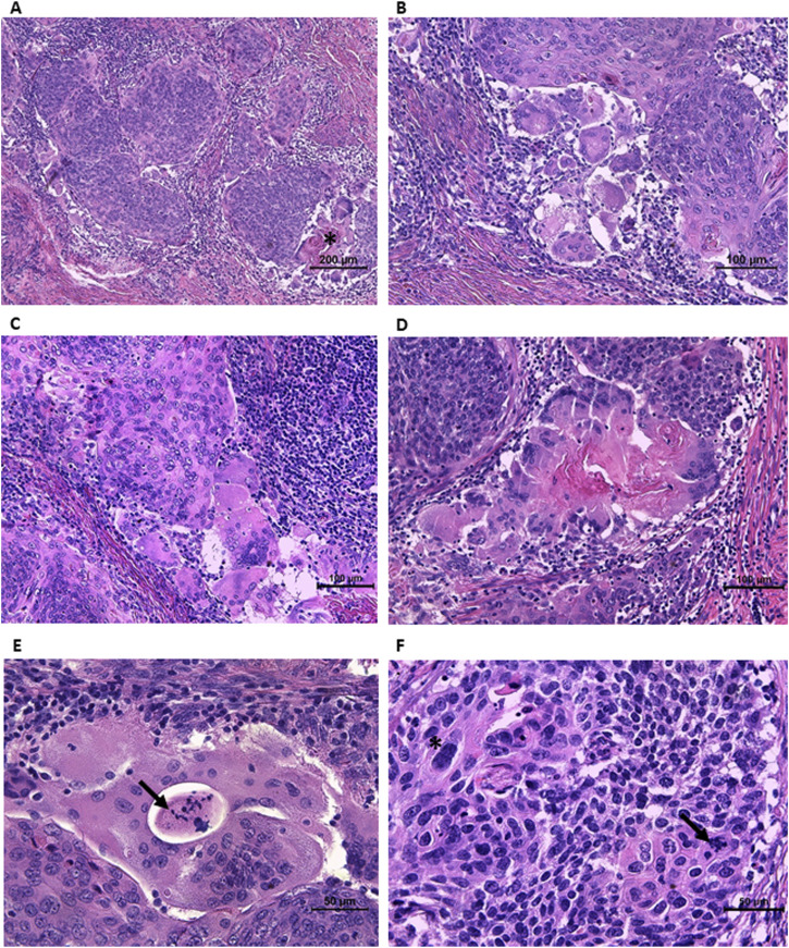 Case Report: Osteoclastic giant cell-rich cervical squamous cell carcinoma-the first reported case of a clinically silent early-detected keratinizing subtype with a detailed literature comparison.
