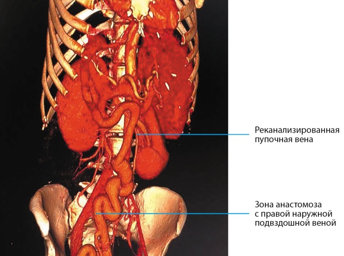 [Hepatogenic diabetes: three cases report and literature review].