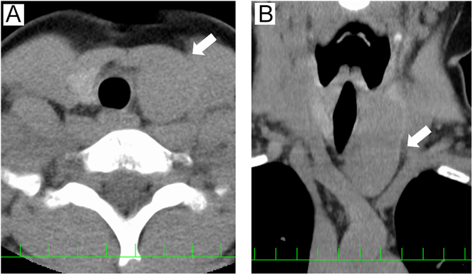 Spindle epithelial tumor with thymus-like elements (SETTLE): a surgical case diagnosed preoperatively using fine-needle aspiration cytology.