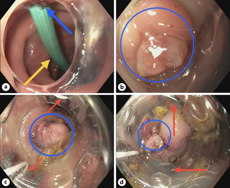 Successful Closure of Chronic Colonic Double Perforation Caused by a Plastic Biliary Stent with Over-the-Scope Clip.