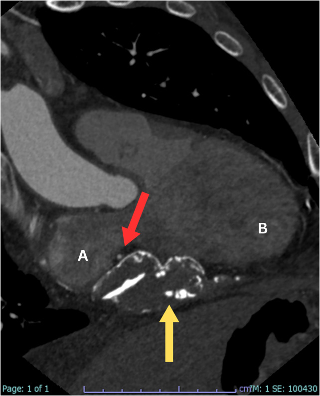 Unveiling Post-Pericardial Resection: <i>Magnificent Imaging of Extensive Residual Pericardial Calcification and Impressive Mitral Valve Thickening</i>.