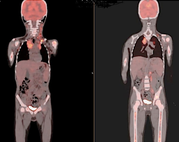 Successful Treatment of Childhood Hodgkin Lymphoma and Secondary Myelofibrosis Resistant to Intensive Therapy, Including Allogeneic Transplantation