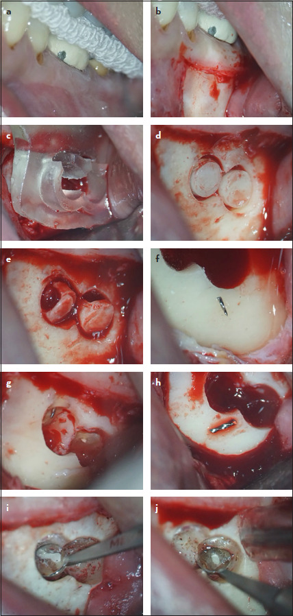 Targeted Endodontic Microsurgery of a Mandibular First Molar with a Separated Instrument Using the 3D-printed Guide and Trephine Bur: A Case Report with a 2-year Follow-up.