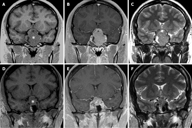 Specific imaging features of sellar atypical teratoid/rhabdoid tumor or the lack of thereof.