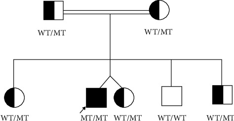 Permanent Congenital Hypothyroidism due to Rare Thyroglobulin Gene Variant (p.Cys1476Arg): A Delayed Diagnosis of Thyroid Dyshormonogenesis.