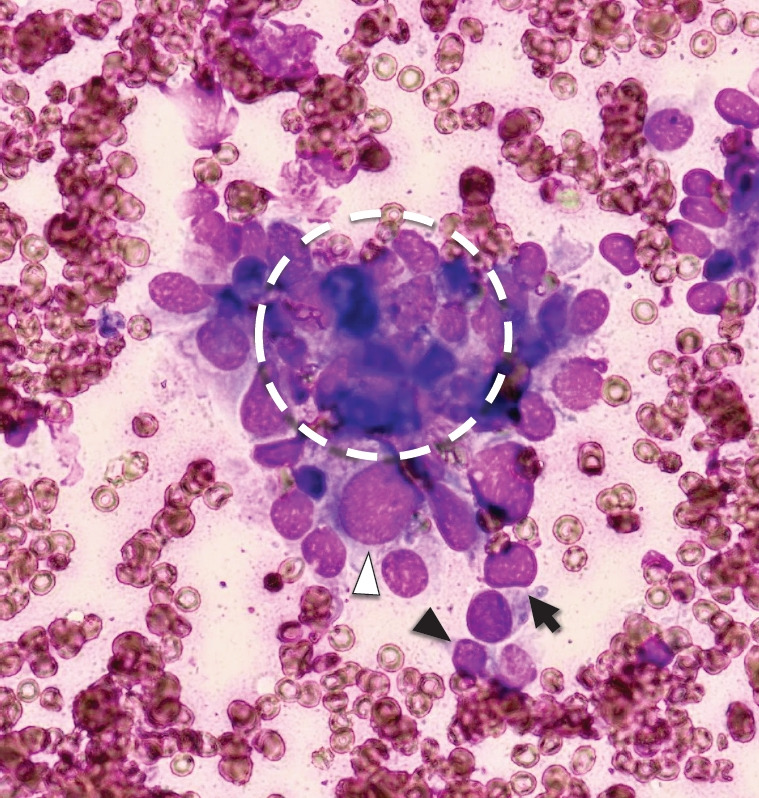 In-room cytologic evaluation by trained endosonographer for determination of procedure end in endoscopic ultrasound-guided fine needle biopsy of solid pancreatic lesions: a prospective study in Taiwan.