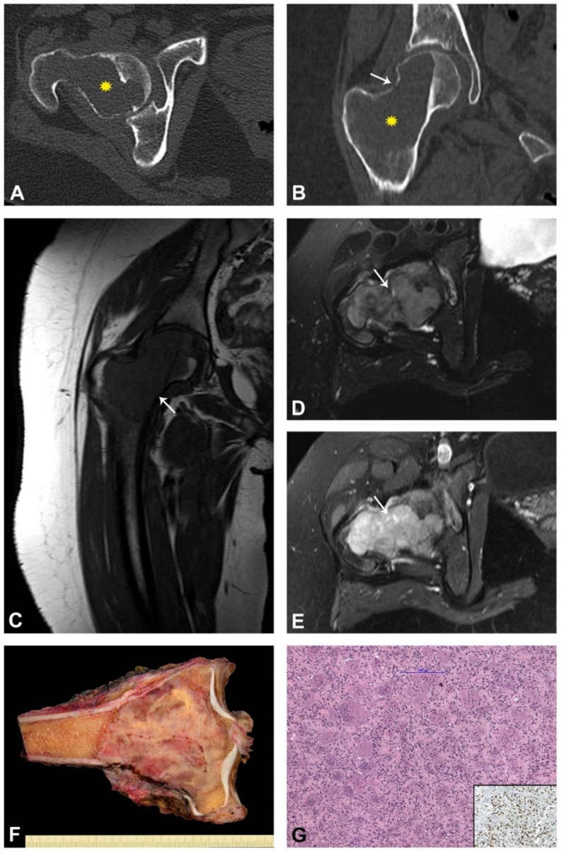 Surgical and radiological outcomes of giant cell tumor of the bone: prognostic value of Campanacci grading and selective use of denosumab.