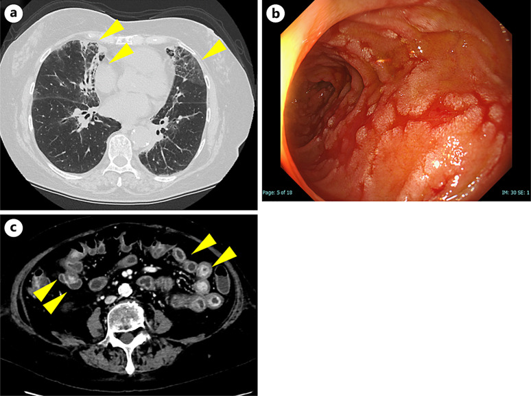 Consecutive Uncontrolled Gastrointestinal Immune-Related Adverse Events Induced by Pembrolizumab in a Patient with Lung Adenocarcinoma: A Case Report.