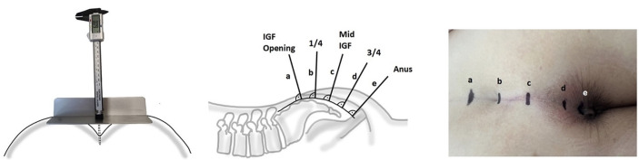 Intergluteal fold depth has no influence on pilonidal sinus disease development.