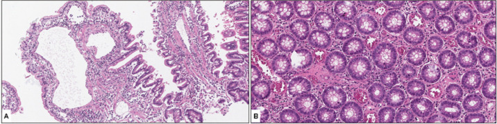 Vitamin K deficiency as a cause of oral bleeding in a dog with intestinal malabsorption due to lymphocytic-plasmacytic enteritis.