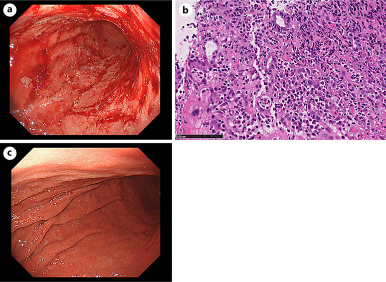 Consecutive Uncontrolled Gastrointestinal Immune-Related Adverse Events Induced by Pembrolizumab in a Patient with Lung Adenocarcinoma: A Case Report.