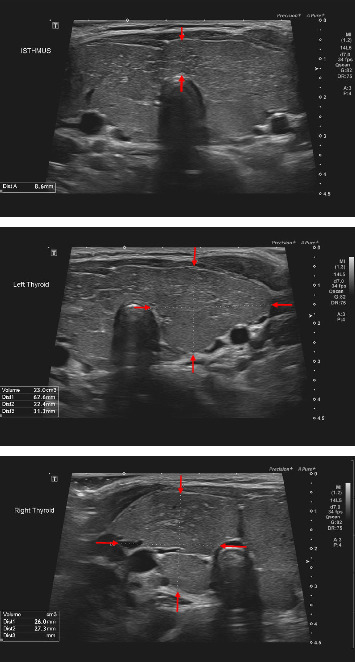 Permanent Congenital Hypothyroidism due to Rare Thyroglobulin Gene Variant (p.Cys1476Arg): A Delayed Diagnosis of Thyroid Dyshormonogenesis.