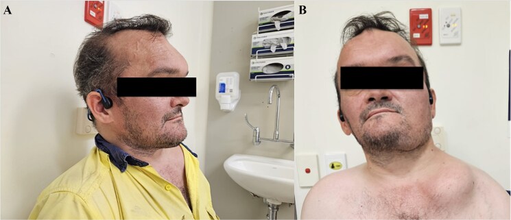 McCune-Albright syndrome: a case of an adult with fibrous dysplasia, severe cardiopulmonary complications, acromegaly, and chronic myeloid leukemia.