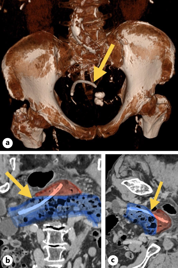 Successful Closure of Chronic Colonic Double Perforation Caused by a Plastic Biliary Stent with Over-the-Scope Clip.